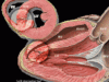 inima infarct