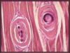 trichineloza