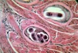 trichineloza