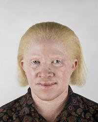 albinos african