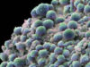Tratamentul pentru cancerul de prostata creste riscul de cancer la colon