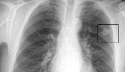 Nefumatorii se pot imbolnavi si ei de cancer pulmonar