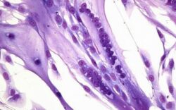 Celule imunitare modificate genetic, ultima sansa in lupta impotriva cancerului