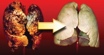 Fumătorii români ard zilnic 5 milioane de pachete cu ţigări. Au viciul 85 la sută dintre bolnavii de cancer bronhopulmonar Fum?torii români ard zilnic 5 milioane de pachete cu ?ig?ri. Au viciul 85 la sut? dintre bolnavii de cancer bronhopulmonar